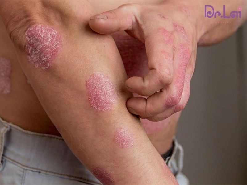 Các bệnh tự miễn ngoài da thường gặp nhất hiện nay