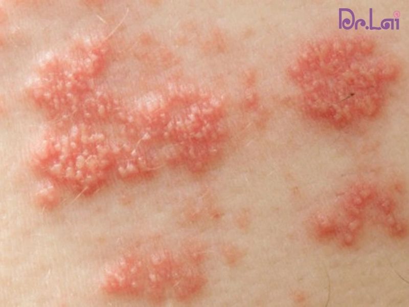 Các bệnh tự miễn ngoài da thường gặp nhất hiện nay