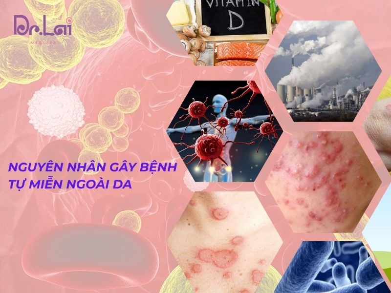 Nguyên nhân gây bệnh tự miễn ngoài da