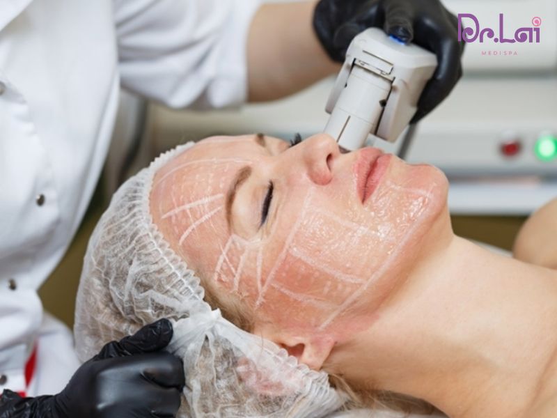 HUFU là phương pháp xóa nhăn căng da không xâm lấn