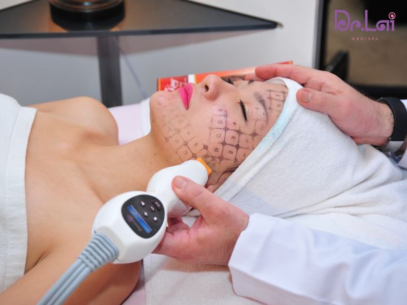 Thermage dựa trên nguyên lý bước sóng RF