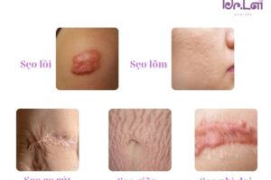 Cắt đáy sẹo