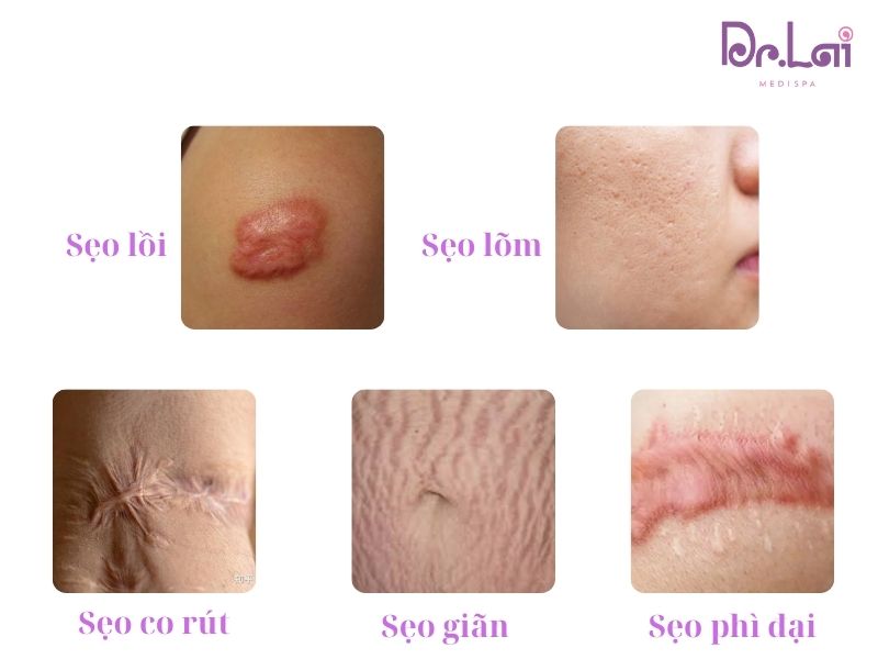 Các loại sẹo phổ biến