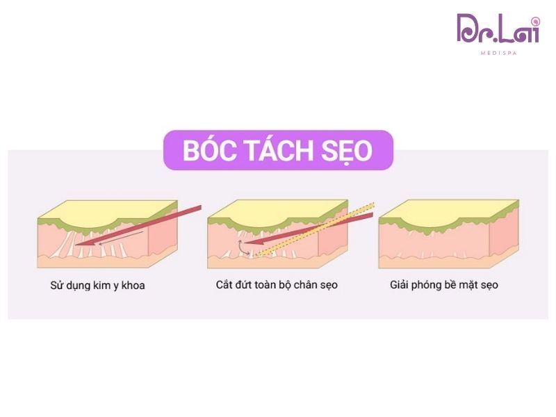 Phương pháp cắt đáy sẹo rỗ tốt nhất hiện nay