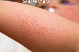 Da bị nhiễm ký sinh trùng