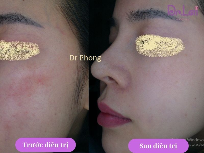 Hình ảnh khách hàng trước và sau khi trị bệnh da liễu tại Dr Lai
