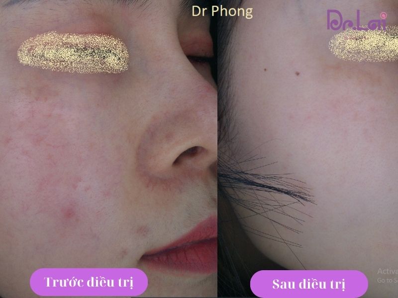 Hình ảnh khách hàng trước và sau khi trị bệnh da liễu tại Dr Lai