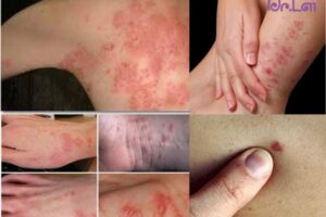 Điều trị các bệnh về da