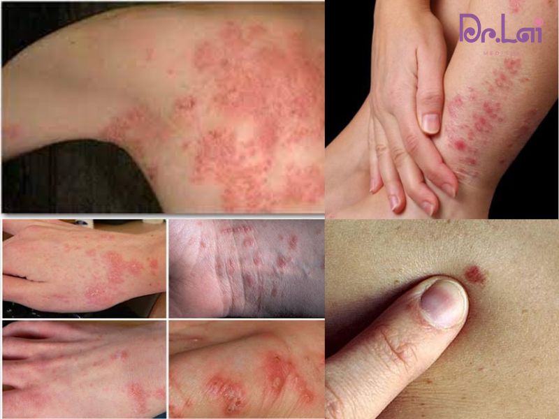 Các bệnh về da thường gặp