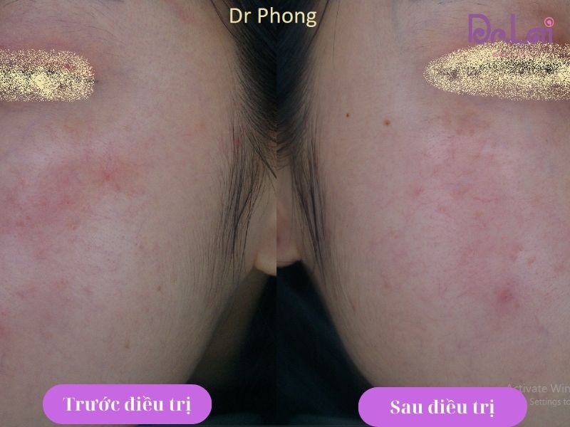 Hình ảnh khách hàng trước và sau khi trị bệnh da liễu tại Dr Lai