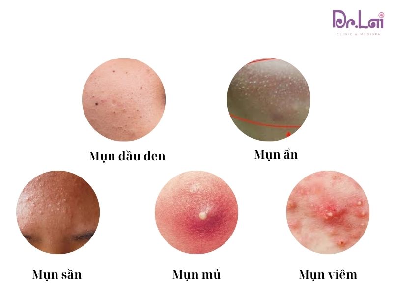 Tình trạng da mụn của mỗi người là khác nhau