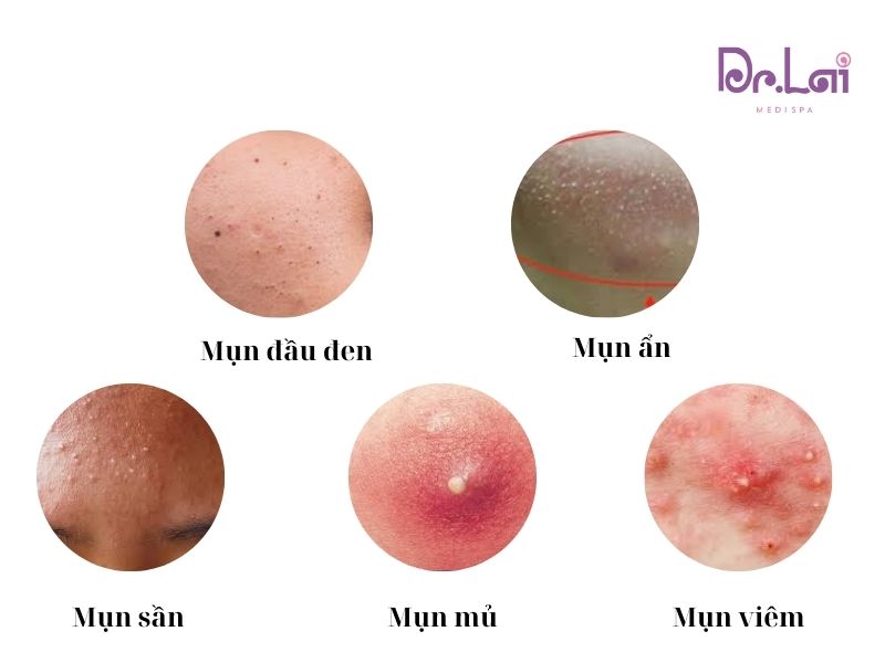 Các loại mụn phổ biến trên da