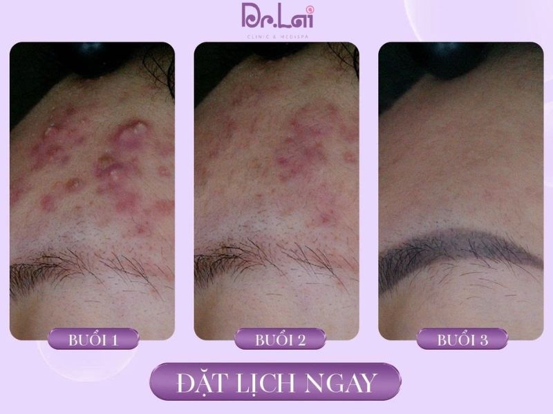 Hiệu quả rõ rệt trên da sau 3 buổi điều trị mụn tại Dr. Lai