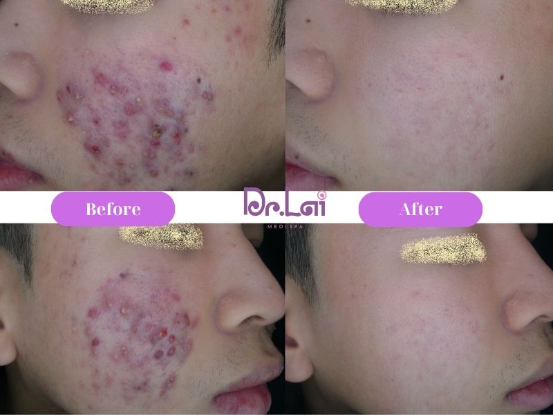 Hiệu quả đạt được sau khi làm dịch vụ trị mụn tại da liễu Dr Lai