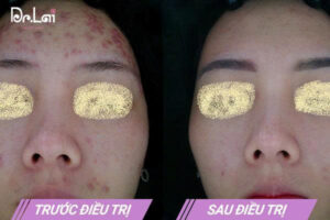 Ảnh khách hàng trước và sau khi điều trị mụn tại Dr Lai