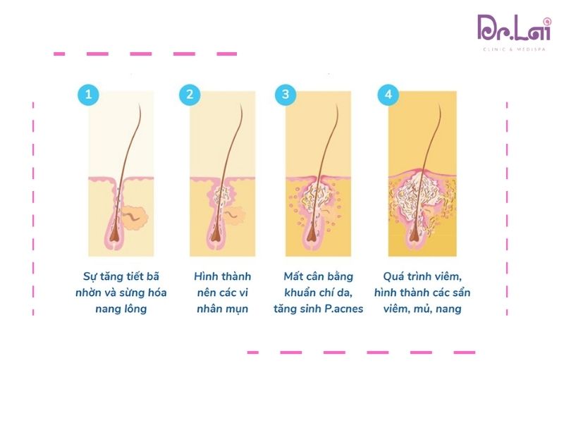 Mụn xuất hiện với nhiều yếu tố khác nhau