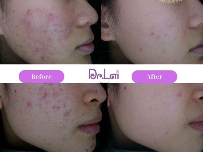 Hiệu quả đạt được sau khi làm dịch vụ trị mụn tại da liễu Dr Lai
