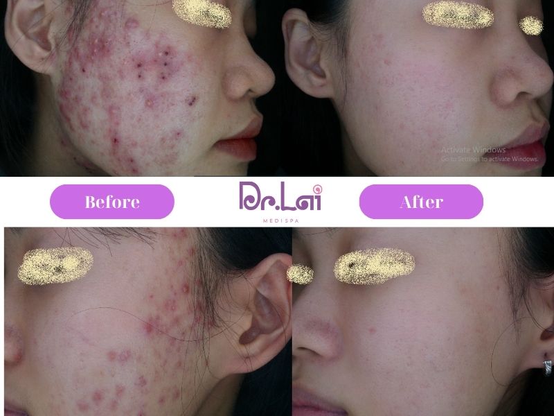Hiệu quả đạt được sau khi làm dịch vụ trị mụn tại da liễu Dr Lai