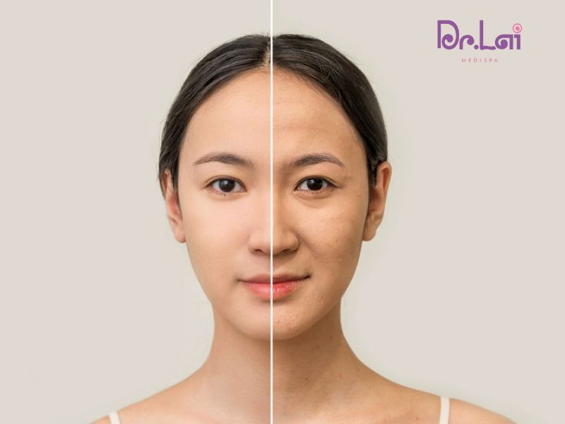 Công nghệ làm đẹp da Hifu so với các phương pháp khác