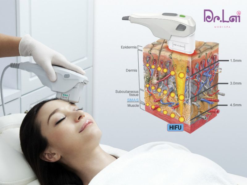 Quy trình khi làm dịch vụ Hifu tại Dr. Lai