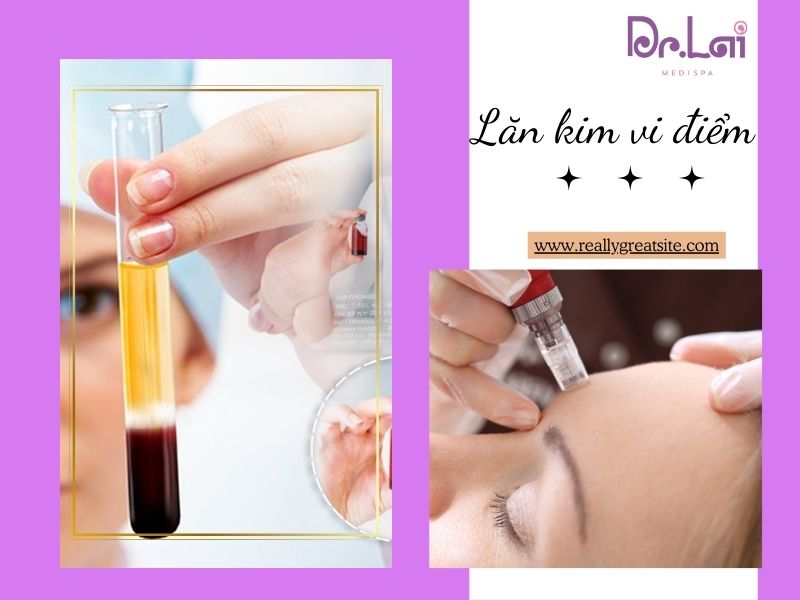 Công nghệ phi kim vi điểm là gì?