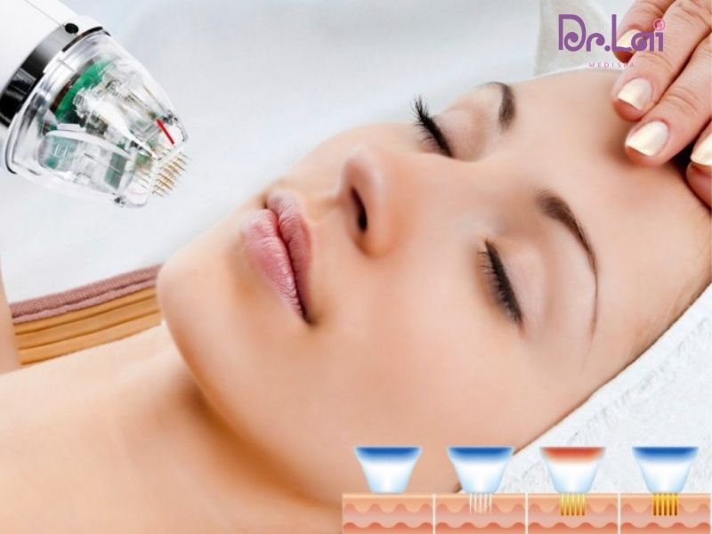 Nguyên lý hoạt động của công nghệ phi kim vi điểm tế bào gốc