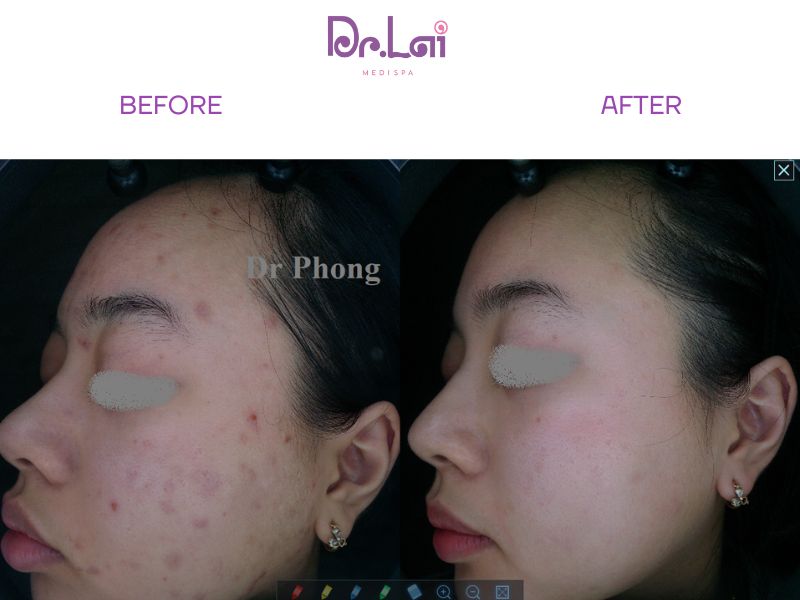 Làn da giảm thâm mụn rõ rệt khi điều trị tại Dr. Lai