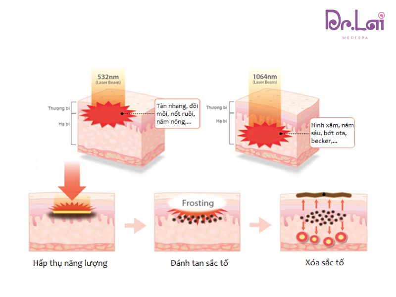 Trị thâm mụn bằng phương pháp Laser YAG hiệu quả như thế nào?