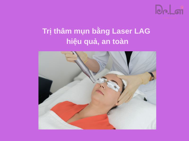Quy trình trị thâm mụn bằng laser YAG chuẩn y khoa
