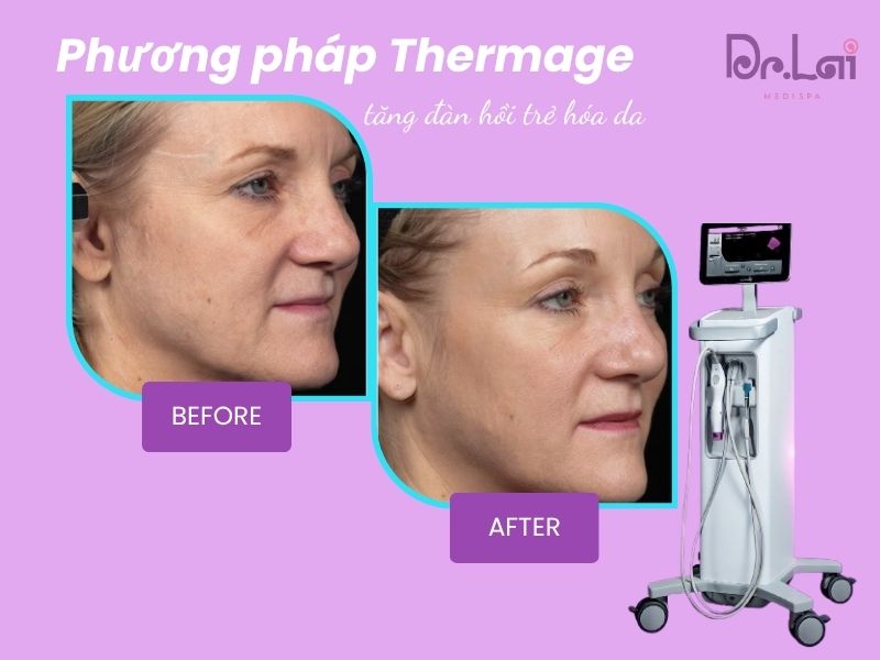 Phương pháp Thermage căng da, trẻ hóa