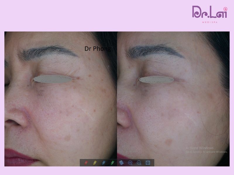 Hình ảnh thực tế của khách với làn da được cải thiện rõ rệt sau khi điều trị tại Dr. Lai