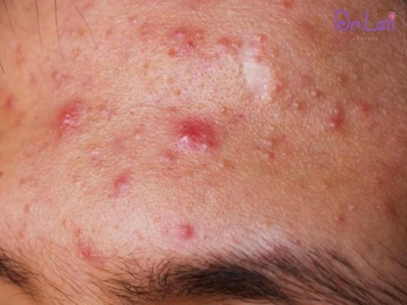 Nguyên nhân chính gây mụn trên mặt