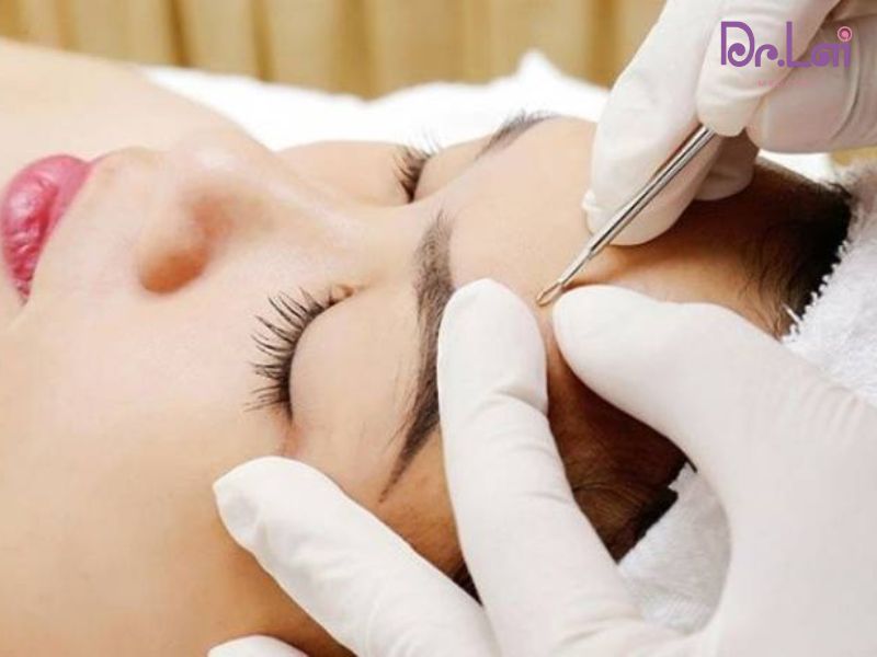 Phương pháp trị liệu mụn ở mặt hiện nay
