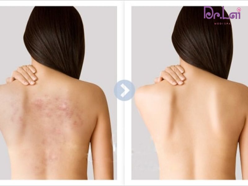 Lợi ích khi trị liệu mụn cơ thể tại Dr Lai