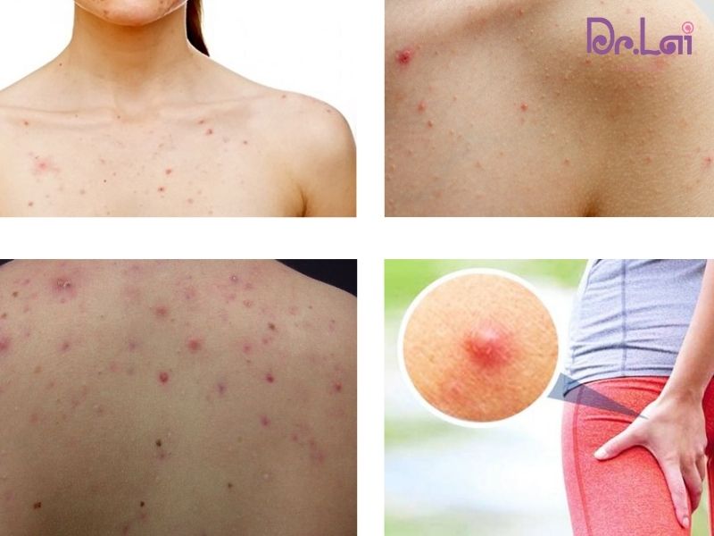 Các vùng thường bị mụn cơ thể
