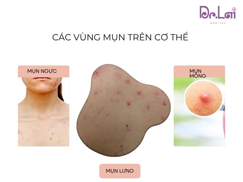 Các vùng thường bị mụn cơ thể