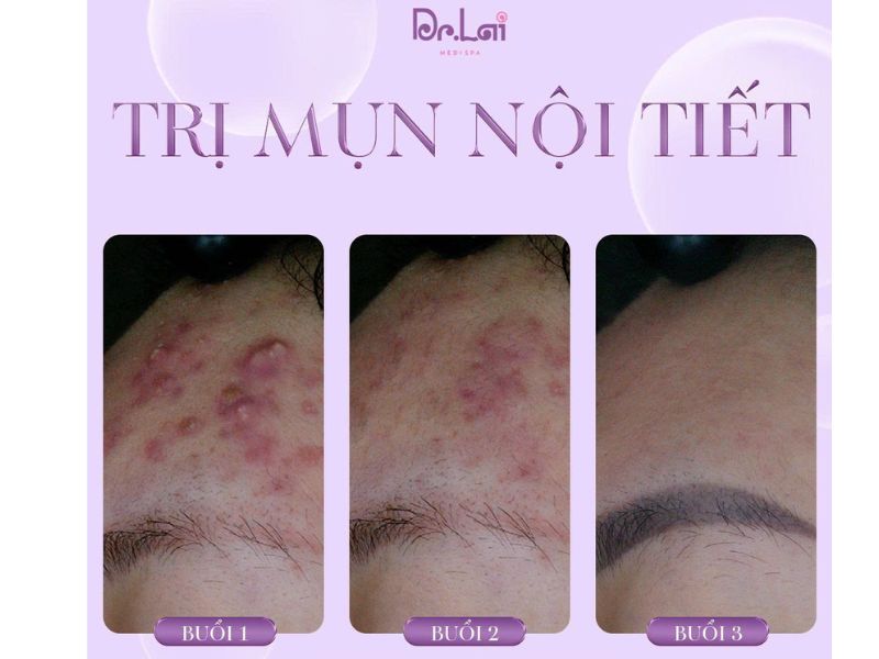 Phương pháp trị liệu mụn ở mặt hiện nay