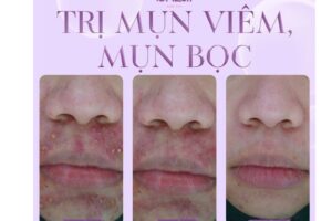 Trị liệu mụn ở mặt