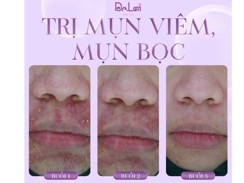 Lợi ích khi điều trị mụn đúng cách