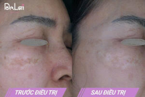Ảnh khách hàng trước và sau khi trị nám, tàn nhang tại Dr Lai