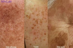 Trị nám tàn nhang đồi mồi