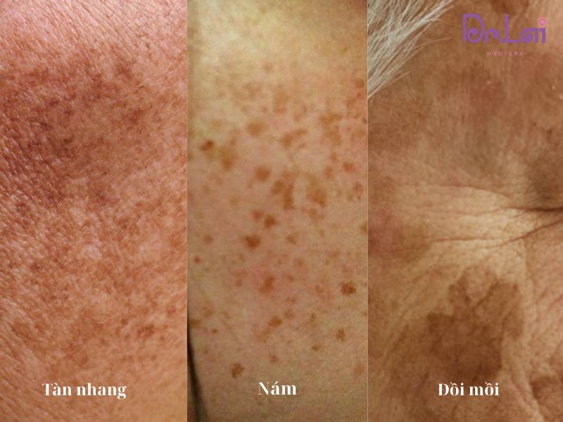 Phân biệt nám tàn nhan và đồi mồi