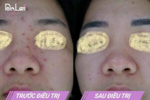 Ảnh khách hàng trước và sau khi trị sẹo tại Dr Lai