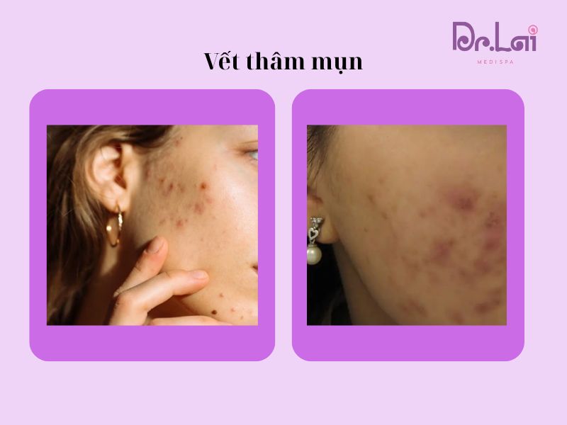 Vết thâm hình thành sau mụn gây mất thẩm mỹ