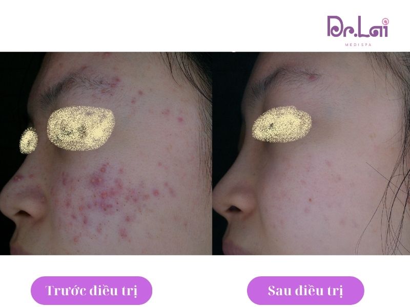 Hình ảnh thực tế khách hàng trước và sau khi trị thâm mụn tại Dr Lai