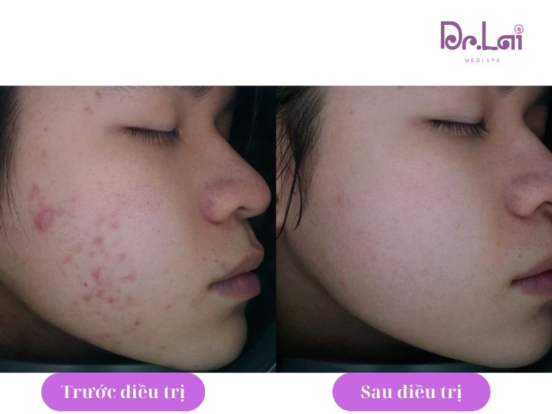 Hình ảnh thực tế khách hàng trước và sau khi trị thâm mụn tại Dr Lai