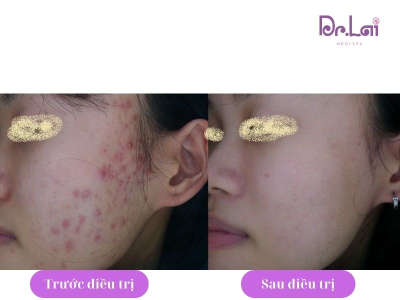 Hình ảnh thực tế khách hàng trước và sau khi trị thâm mụn tại Dr Lai