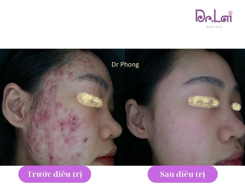 Hình ảnh điều trị thâm sau mụn của khách được cải thiện rõ rệt
