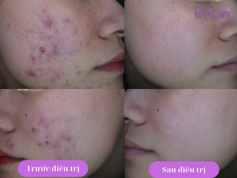Trị thâm mụn bằng phương pháp Laser IPL hiệu quả như thế nào?