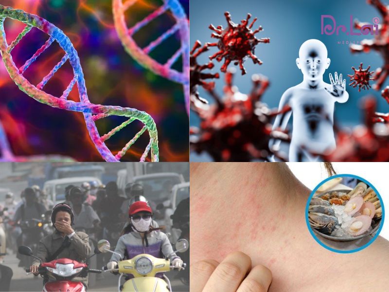 Nguyên nhân dẫn đến viêm da cơ địa